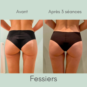 Avant-après fesses-2