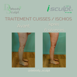 i-sculpt cuisses ischios