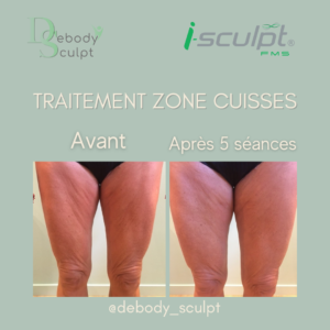 Traitement cuisses I-Sculpt